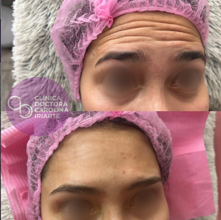 Antes y después de tratamiento con botox en la frente
