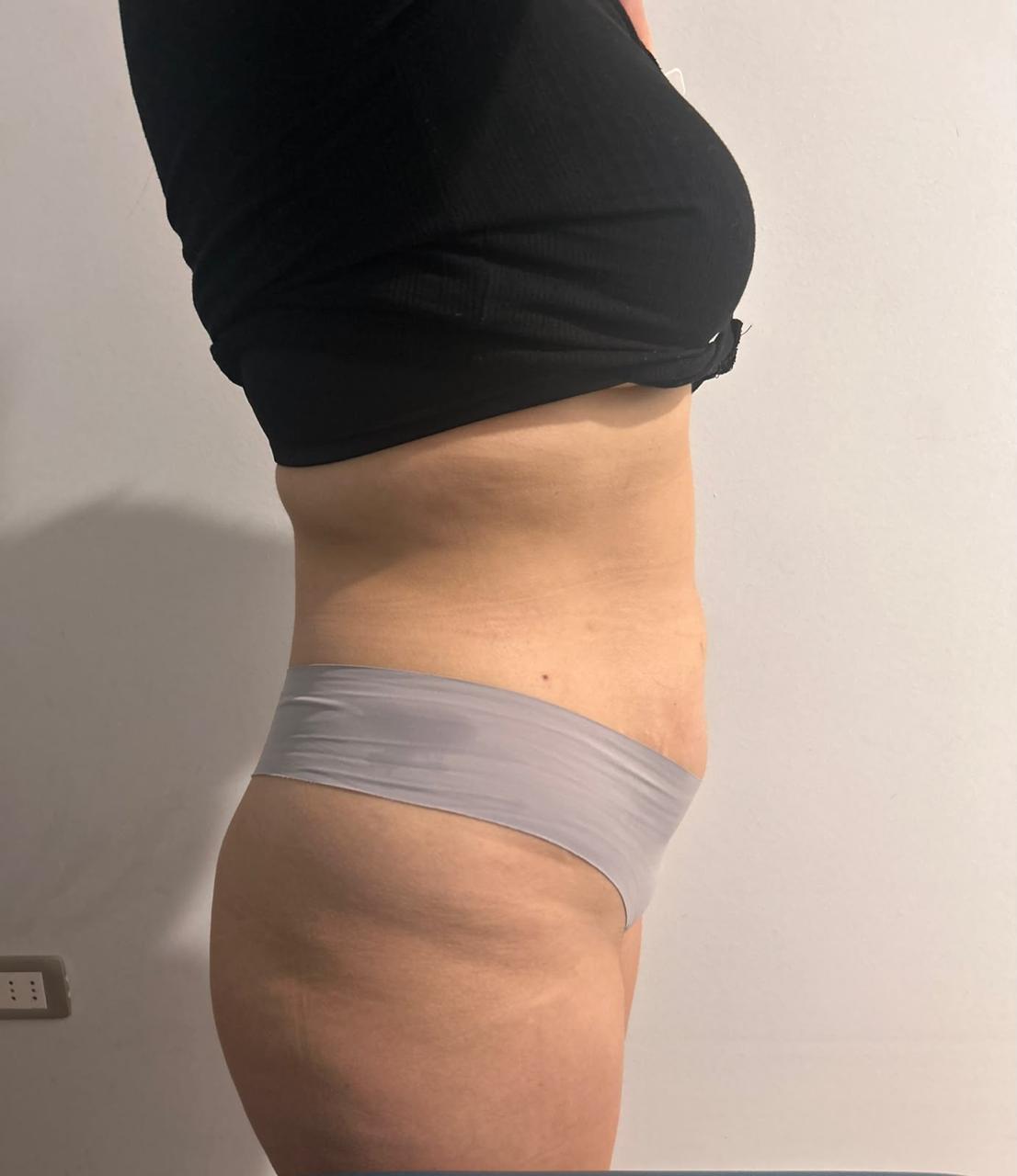 Después de tratamiento Endoláser de abdomen